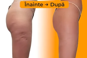 Cavitatie - Rezultate inainte si dupa procedura | Salon remodelare corporala Bucuresti Sector 3 | Rainbow Energy